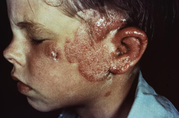 Photograph of tinea faciei.